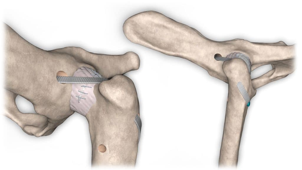 Stabilisation Extra Articulaire De La Luxation Cranio Dorsale De La